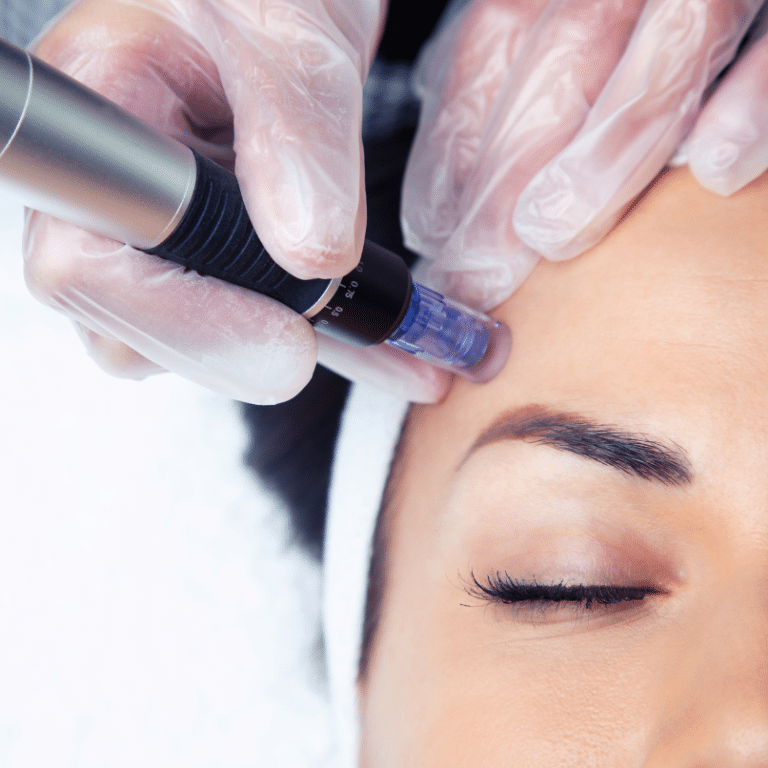 Microneedling in Battle Creek