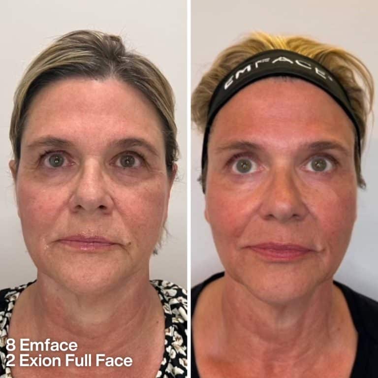 before and after emface