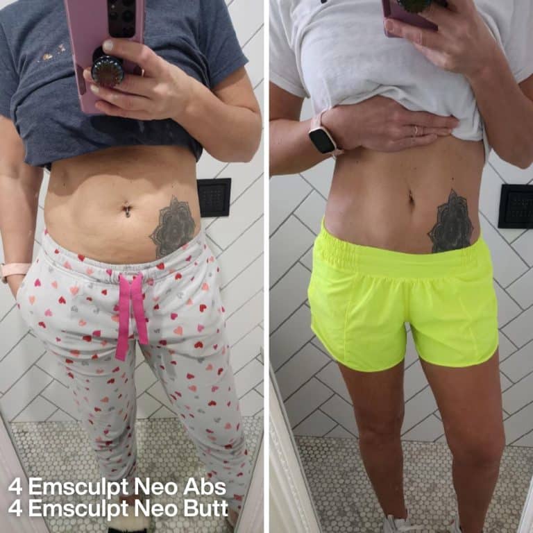 before and after emsculpt