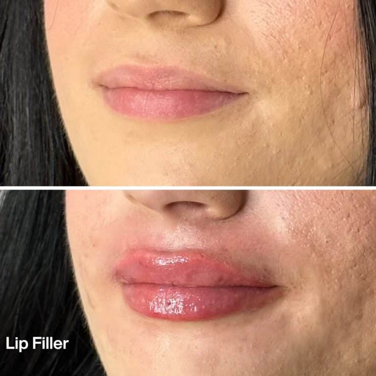 lip filler before and after