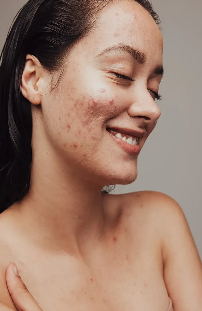 Girl with acne