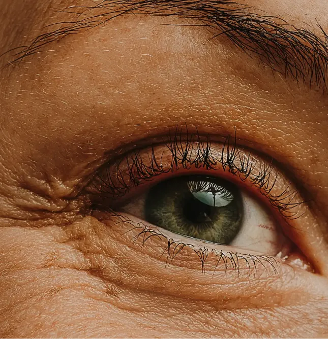 Eye with dark cirlce
